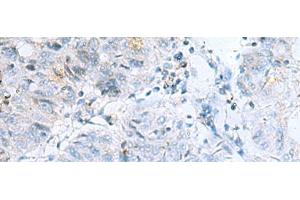 Immunohistochemistry of paraffin-embedded Human colorectal cancer tissue using POMC Polyclonal Antibody at dilution of 1:35(x200) (POMC 抗体)