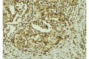 ABIN6273150 at 1/100 staining Human breast cancer tissue by IHC-P. (PRPF8 抗体  (C-Term))