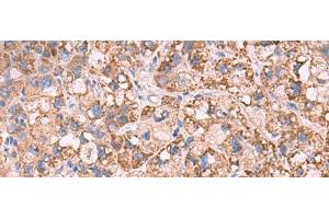Immunohistochemistry of paraffin-embedded Human liver cancer tissue using KCNN1 Polyclonal Antibody at dilution of 1:55(x200) (KCNN1 抗体)