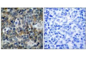 Immunohistochemical analysis of paraffin-embedded human tonsil carcinoma tissue, using VASP (phospho-Ser238) antibody (E011158). (VASP 抗体  (pSer238))
