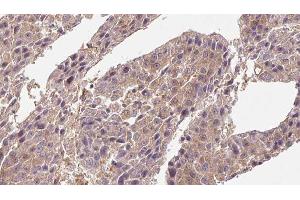 ABIN6276716 at 1/100 staining Human liver cancer tissue by IHC-P. (CD4 抗体  (C-Term))