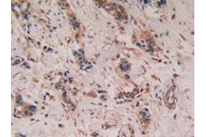 IHC-P analysis of Human Breast Cancer Tissue, with DAB staining. (PTGS2 抗体  (AA 418-589))