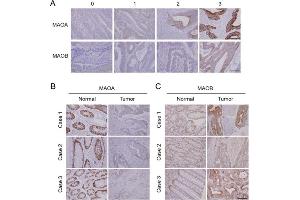 Immunohistochemical (IHC) results of monoamine oxidase A (MAOA) and MAOB expressions in a Taiwanese colorectal cancer cohort. (Monoamine Oxidase A 抗体  (Center))