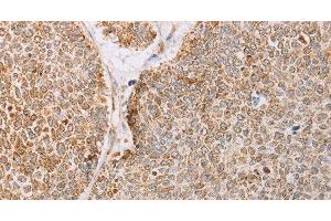Immunohistochemistry of paraffin-embedded Human lung cancer tissue using YARS2 Polyclonal Antibody at dilution 1:30 (YARS2 抗体)