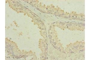 Immunohistochemistry of paraffin-embedded human prostate cancer using ABIN7172904 at dilution of 1:100