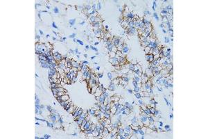 Immunohistochemistry of paraffin-embedded human colon carcinoma using LGALS8 antibody. (LGALS8 抗体)