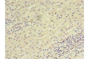 Immunohistochemistry of paraffin-embedded human liver cancer using ABIN7168458 at dilution of 1:100 (UTP23 抗体  (AA 1-249))