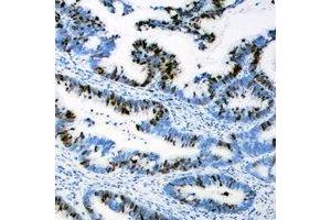 Immunohistochemical analysis of AEBP2 staining in human colon cancer formalin fixed paraffin embedded tissue section. (AEBP2 抗体)