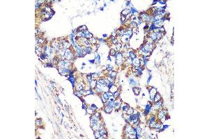 Immunohistochemistry of paraffin-embedded Human colon carcinoma using STNL Rabbit pAb (ABIN7270585) at dilution of 1:100 (40x lens). (STARD3NL 抗体  (AA 185-234))