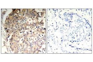 Immunohistochemical analysis of paraffin-embedded human breast carcinoma tissue using SHP-1(Phospho-Tyr536) Antibody(left) or the same antibody preincubated with blocking peptide(right). (SHP1 抗体  (pTyr536))