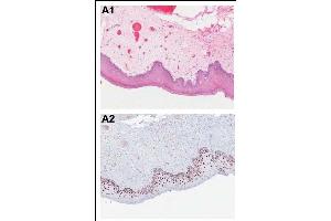 Immunohistochemical analysis of PDCD4 shows the corresponding H&E-stained and PDCD4-stained tissue sections from patients with OSCC. (PDCD4 抗体  (pSer457))