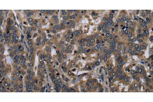 Immunohistochemistry of paraffin-embedded Human liver cancer tissue using FGF18 Polyclonal Antibody at dilution 1:40 (FGF18 抗体)