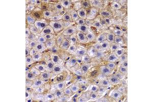 Immunohistochemistry of paraffin-embedded human liver cancer using TCTN3 antibody at dilution of 1:100 (40x lens). (TCTN3 抗体)