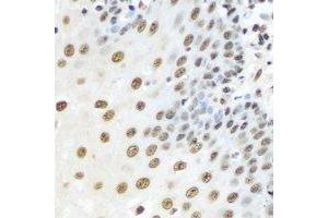 Immunohistochemical analysis of Karyopherin alpha-3 staining in human esophageal cancer formalin fixed paraffin embedded tissue section. (KPNA3 抗体)
