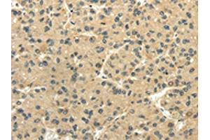 The image on the left is immunohistochemistry of paraffin-embedded Human liver cancer tissue using ABIN7131516(TULP2 Antibody) at dilution 1/20, on the right is treated with fusion protein. (TULP2 抗体)