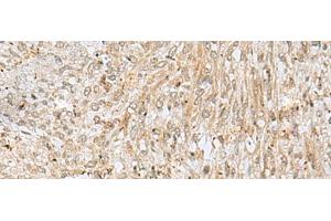 Immunohistochemistry of paraffin-embedded Human liver cancer tissue using NUP58 Polyclonal Antibody at dilution of 1:50(x200) (NUPL1 抗体)