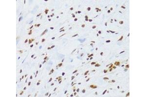 Immunohistochemistry of paraffin-embedded Human gastric cancer using DDB1 Polyclonal Antibody at dilution of 1:100 (40x lens). (DDB1 抗体)