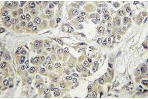 Immunohistochemistry (IHC) analyzes of Tyk 2 antibody in paraffin-embedded human breast carcinoma tissue. (TYK2 抗体)