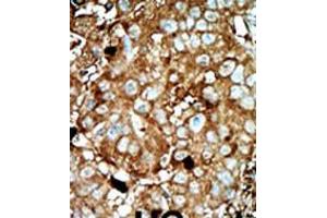 Formalin-fixed and paraffin-embedded human cancer tissue reacted with the primary antibody, which was peroxidase-conjugated to the secondary antibody, followed by AEC staining. (PFKFB3 抗体  (C-Term))