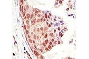 IHC analysis of FFPE human breast carcinoma tissue stained with the SUMO antibody (SUMO1 抗体  (AA 55-86))