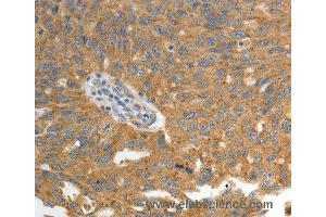 Immunohistochemistry of Human ovarian cancer using GRK4 Polyclonal Antibody at dilution of 1:40