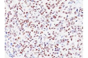 Formalin-fixed, paraffin-embedded human Melanoma stained with MITF Mouse Monoclonal Antibody (SPM290) (MITF 抗体)