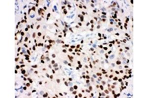 IHC-P: Progesterone Receptor antibody testing of human breast cancer tissue (Progesterone Receptor 抗体  (AA 595-933))