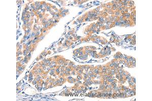 Immunohistochemistry of Human breast cancer using ART4 Polyclonal Antibody at dilution of 1:30 (ART4 抗体)