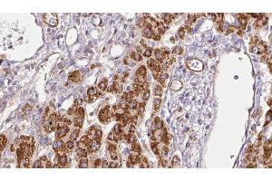 ABIN6278272 at 1/100 staining Human liver cancer tissue by IHC-P. (SLC9A3R1 抗体  (Internal Region))