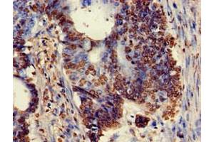 Immunohistochemistry of paraffin-embedded human colon cancer using ABIN7175897 at dilution of 1:100