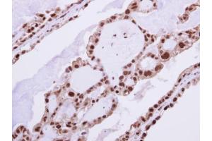 IHC-P Image Immunohistochemical analysis of paraffin-embedded human ovarian cancer, using RAD23B, antibody at 1:250 dilution. (RAD23B 抗体  (Center))