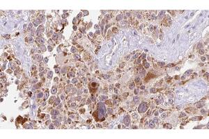 ABIN6273235 at 1/100 staining Human Melanoma tissue by IHC-P. (EGFL7 抗体  (Internal Region))