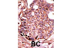 Formalin-fixed and paraffin-embedded human cancer tissue reacted with SEPHS2 polyclonal antibody  , which was peroxidase-conjugated to the secondary antibody, followed by DAB staining.