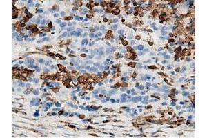 Immunohistochemical staining of paraffin-embedded Adenocarcinoma of Human colon tissue using anti-ARHGAP25 mouse monoclonal antibody. (ARHGAP25 抗体)