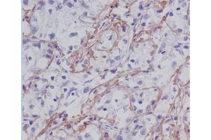 Immunohistochemical analysis of paraffin-embedded human liver cancer, using Fibronectin Antibody. (Recombinant Fibronectin 抗体)