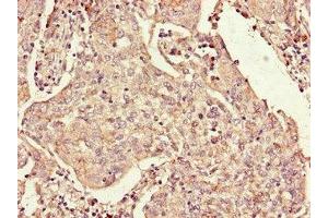 Immunohistochemistry of paraffin-embedded human cervical cancer using ABIN7167815 at dilution of 1:100 (Retinoid X Receptor gamma 抗体  (AA 13-133))