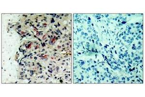 Immunohistochemical analysis of paraffin-embedded human breast carcinoma tissue using JAK1(Ab-1022) Antibody(left) or the same antibody preincubated with blocking peptide(right). (JAK1 抗体  (AA 1020-1024))