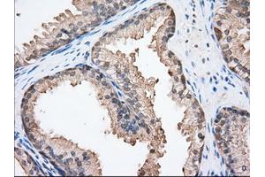 Immunohistochemical staining of paraffin-embedded Adenocarcinoma of Human ovary tissue using anti-BSG mouse monoclonal antibody. (CD147 抗体)