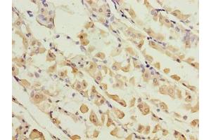Immunohistochemistry of paraffin-embedded human gastric cancer using ABIN7157640 at dilution of 1:100 (KIF26B 抗体  (AA 8-133))