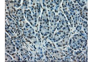 Immunohistochemical staining of paraffin-embedded Adenocarcinoma of colon tissue using anti-STK39mouse monoclonal antibody. (STK39 抗体)