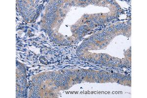 Immunohistochemistry of Human thyroid cancer using BDNF Polyclonal Antibody at dilution of 1:40 (BDNF 抗体)