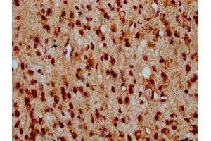 IHC image of ABIN7155865 diluted at 1:500 and staining in paraffin-embedded human glioma performed on a Leica BondTM system. (HIPK2 抗体  (AA 816-977))