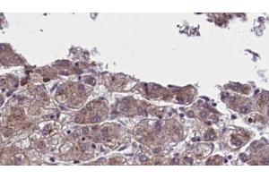 ABIN6273960 at 1/100 staining Human liver cancer tissue by IHC-P. (OR5AN1 抗体  (Internal Region))