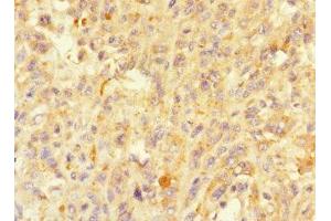 Immunohistochemistry of paraffin-embedded human melanoma using ABIN7160214 at dilution of 1:100 (MORN5 抗体  (AA 1-161))
