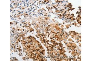 Immunohistochemistry of Human cervical cancer using LCN2 Polyclonal Antibody at dilution of 1:60 (Lipocalin 2 抗体)