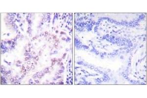Immunohistochemistry analysis of paraffin-embedded human lung carcinoma tissue, using Thyroid Hormone Receptor beta Antibody. (THRB 抗体  (AA 11-60))