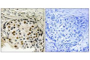 Immunohistochemistry analysis of paraffin-embedded human breast carcinoma tissue using OSR1 (Phospho-Thr185) antibody.