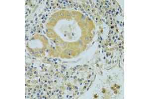 Immunohistochemistry of paraffin-embedded human lung cancer using PECR antibody (ABIN2564466) at dilution of 1:100 (40x lens). (PECR 抗体)