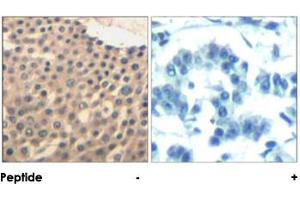 Immunohistochemical analysis of paraffin-embedded human lung carcinoma tissue using HDAC4/HDAC5/HDAC9 polyclonal antibody . (HDAC4 抗体  (Ser220, Ser246, Ser259))