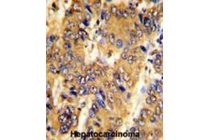 Formalin-fixed and paraffin-embedded human hepatocarcinoma with MSRB2 Antibody (Center), which was peroxidase-conjugated to the secondary antibody, followed by DAB staining. (MSRB2 抗体  (Middle Region))